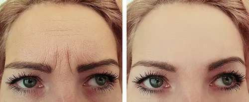 A before and after photo where the elevens, creases in the furrow of the brow, are treated.