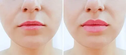 A photo showing how lip fillers increase volume to restore a naturally youthful look to the face.